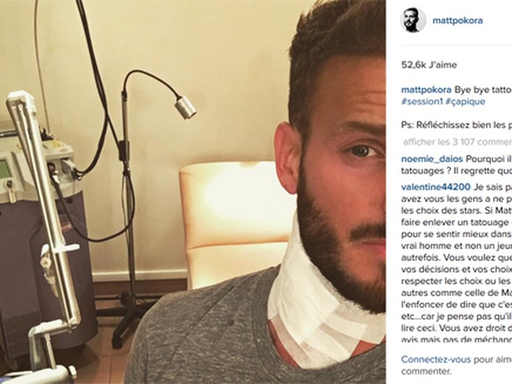 M.Pokora enlève ses tatouages