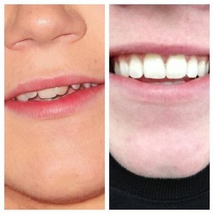 Niall Horan, ce qu'il aime : ses nouvelles dents ! "Avant et après" !