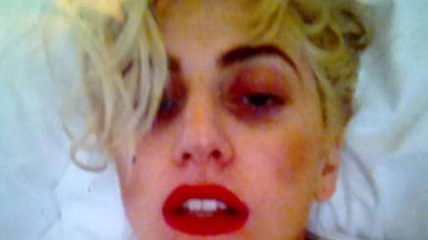 Lady Gaga s’affiche avec son oeil au beurre noir !